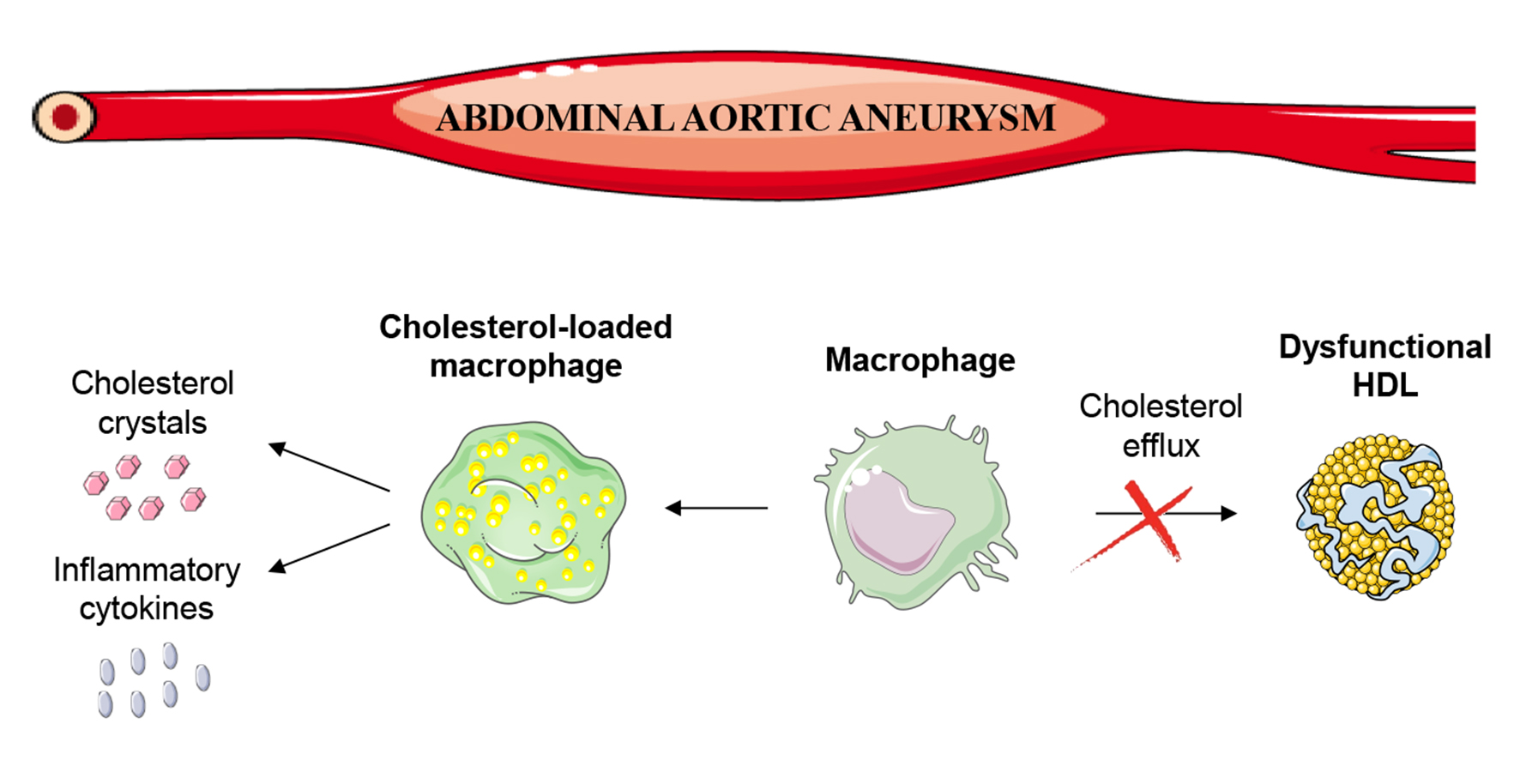 Las lipoproteínas que transportan el colesterol ‘bueno’ pierden su capacidad cardioprotectora en pacientes con aneurisma aórtico abdominal