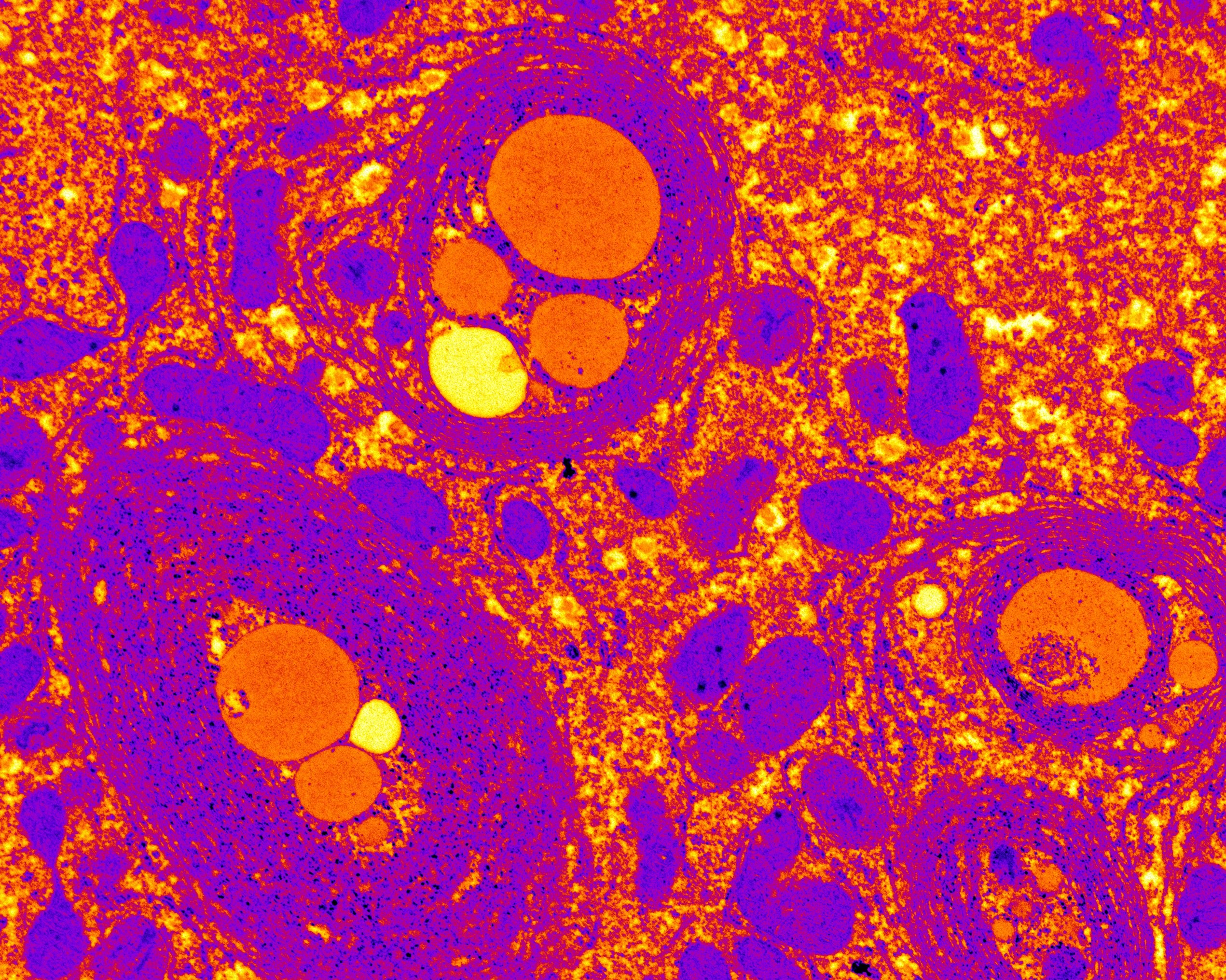 Hallan un nuevo vínculo entre el síndrome metabólico y el cáncer hepático