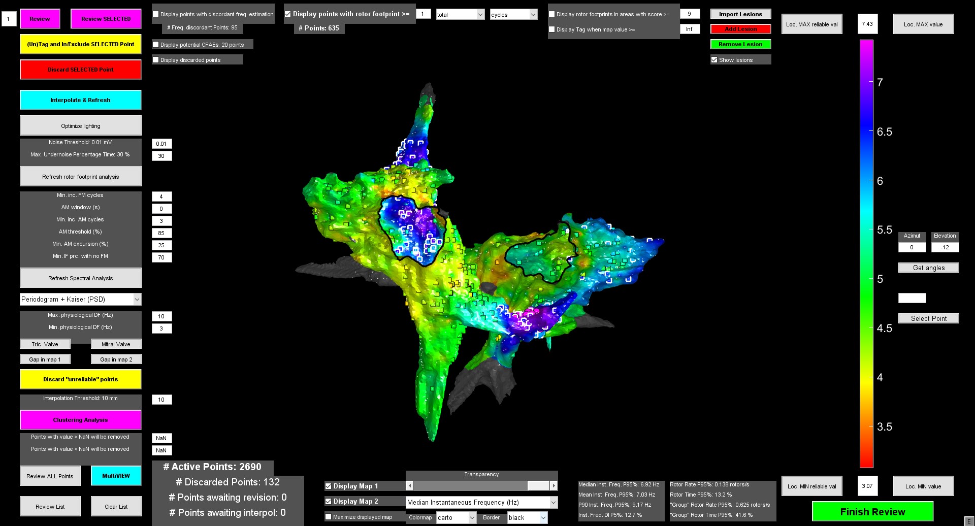 Un nuevo método facilitará la terapia de una de las arritmias más frecuentes, la fibrilación auricular