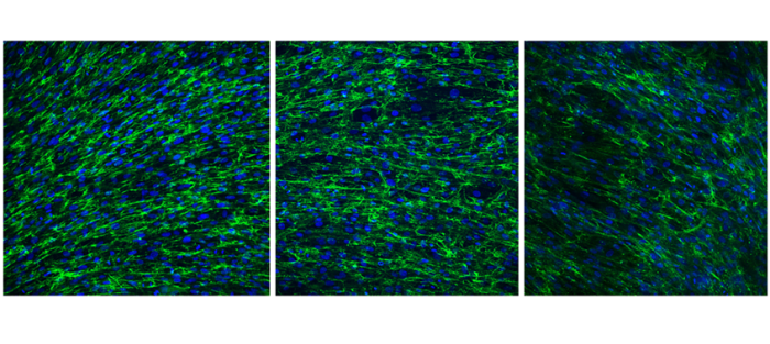 Desarrollan un sistema de inteligencia artificial aplicada al diagnóstico de enfermedades raras relacionadas con el colágeno VI