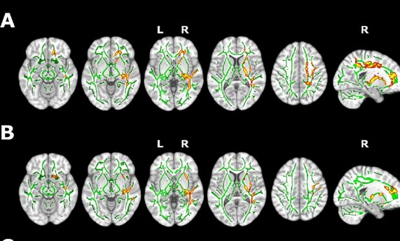 Encuentran cambios en la estructura cerebral y la cognición en personas con insomnio