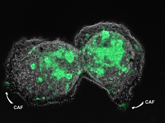 Describen la importancia de la heterogeneidad celular de los tumores en el desarrollo de metastásis