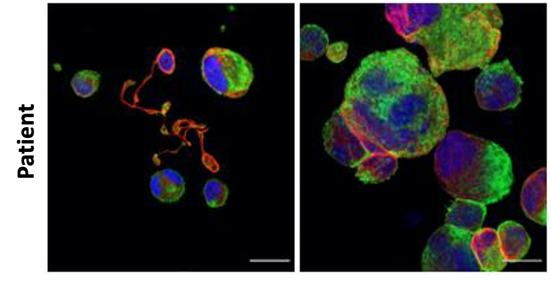 Los pacientes con la trombocitopenia congénita TUBB1-RT muestran una gran heterogeneidad clínica