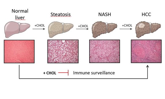 Revelan un papel clave del colesterol pero no de la esteatosis en el desarrollo del carcinoma hepatocelular Revelan un papel clave del colesterol pero no de la esteatosis en el desarrollo del carcinoma hepatocelular