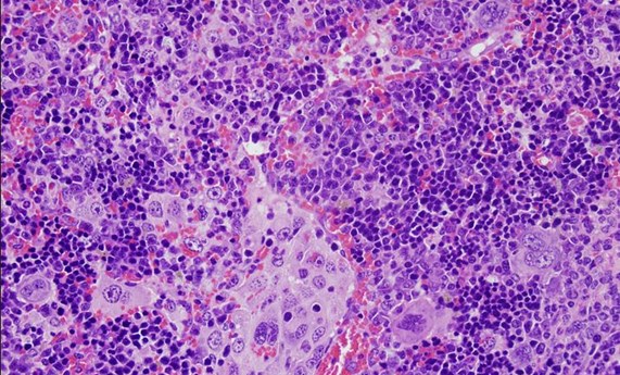 Identificadas alteraciones genéticas en el gen VAV1 relevantes en linfomas Identificadas alteraciones genéticas en el gen VAV1 relevantes en linfomas