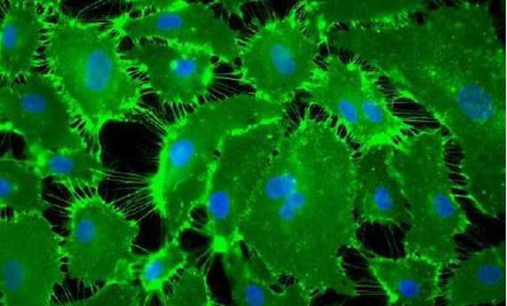 Estudian los mecanismos fisiopatológicos que intervienen en el desarrollo de la hipertensión pulmonar tromboembólica crónica Estudian los mecanismos fisiopatológicos que intervienen en el desarrollo de la hipertensión pulmonar tromboembólica crónica