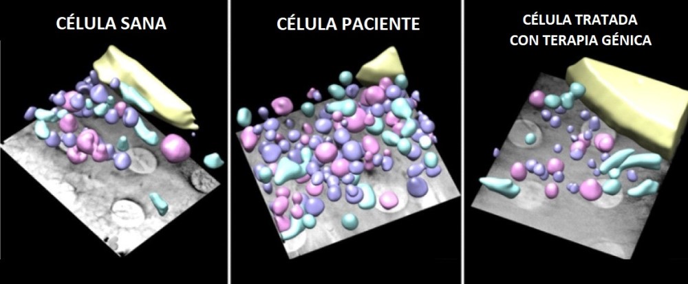 Probada la terapia génica contra la distrofia muscular en células de pacientes
