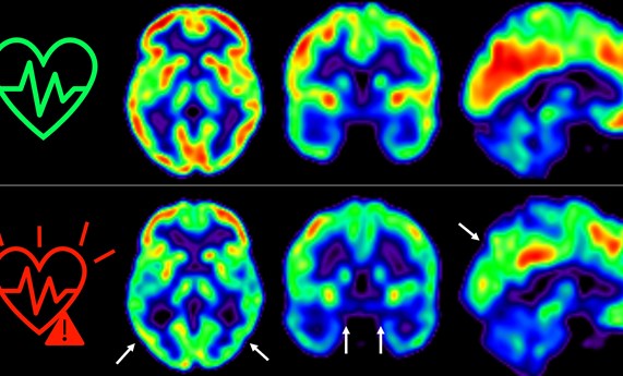 Cuanto antes empecemos a controlar los factores de riesgo cardiovascular, mejor para nuestro cerebro