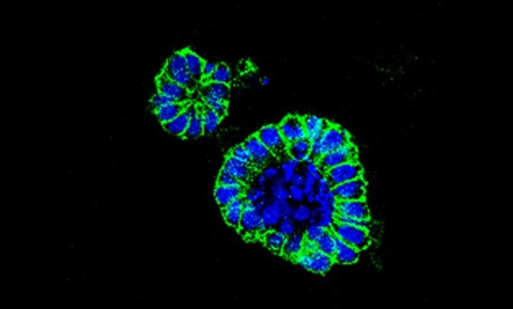 Un nuevo fármaco frente a un transportador de aminoácidos es efectivo en cáncer de colon