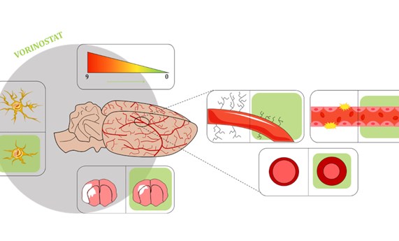 Un fármaco para un tipo de cáncer podría mejorar los síntomas después de un ictus cerebral