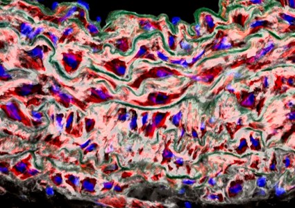 Descubren una nueva causa de los aneurismas de aorta y una posible vía para prevenirlos sin cirugía