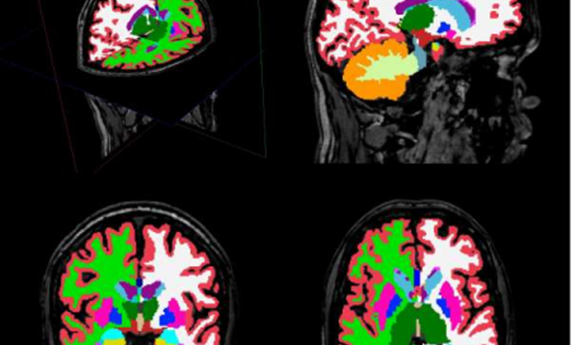 Describen alteraciones en estructuras cerebrales en pacientes con esquizofrenia descubiertas mediante un innovador análisis de imagen cerebral Describen alteraciones en estructuras cerebrales en pacientes con esquizofrenia descubiertas mediante un innovador análisis de imagen cerebral