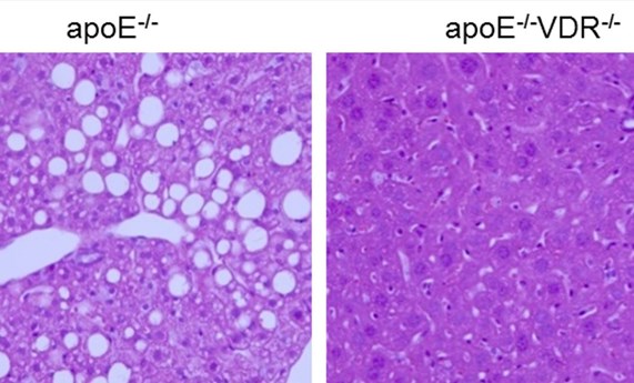 El receptor de vitamina D promueve la esteatosis en la enfermedad del hígado graso no alcohólico El receptor de vitamina D promueve la esteatosis en la enfermedad del hígado graso no alcohólico
