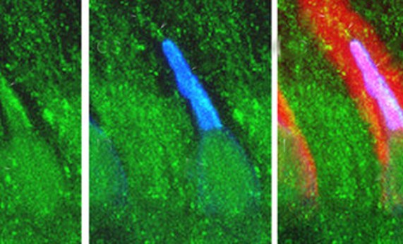 Descubren una nueva variante genética causante de retinitis pigmentosa Descubren una nueva variante genética causante de retinitis pigmentosa