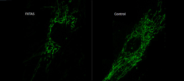 Identifican un nuevo mecanismo mitocondrial implicado en la patogénesis del síndrome FXTAS