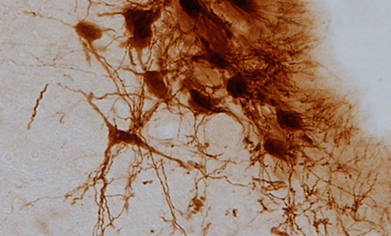 El dolor diabético y la ansiedad comparten un mecanismo cerebral común El dolor diabético y la ansiedad comparten un mecanismo cerebral común