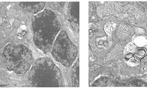 La maquinaria autofágica podría ser una diana terapéutica en tratamientos oculares La maquinaria autofágica podría ser una diana terapéutica en tratamientos oculares